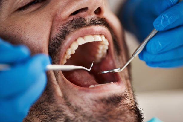 Best Broken or Cracked Tooth Emergency Dentist in Frewsburg, NY