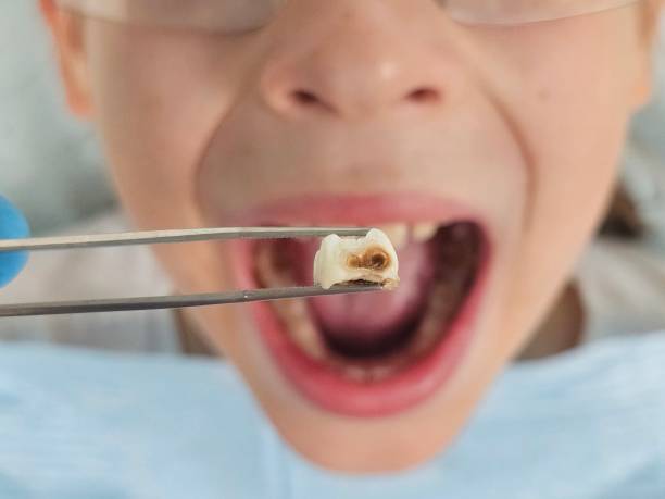 Best Emergency Dentist for Lost Fillings or Crowns in Frewsburg, NY